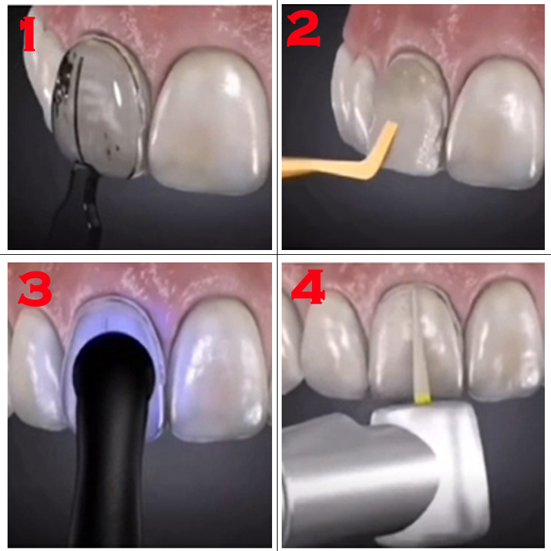 32 Parça Diş Beyazlatma Kalıbı - Teeth Whitening Moulds incelemesi ve fiyatı